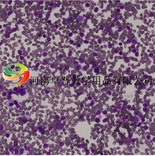 急性粒细胞白血病未分化型M1