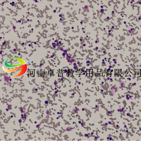 急性粒细胞白血病部分分化型M2